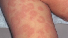 В центре внимания международной недели аллергии – уртикария, или крапивница